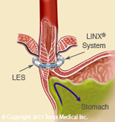 The LINX System Norwalk