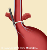 The LINX Reflux Management System The LINX Reflux Management System Norwalk