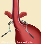 The LINX Reflux Management System The LINX Reflux Management System New London