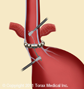 The LINX Reflux Management System The LINX Reflux Management System Shelton